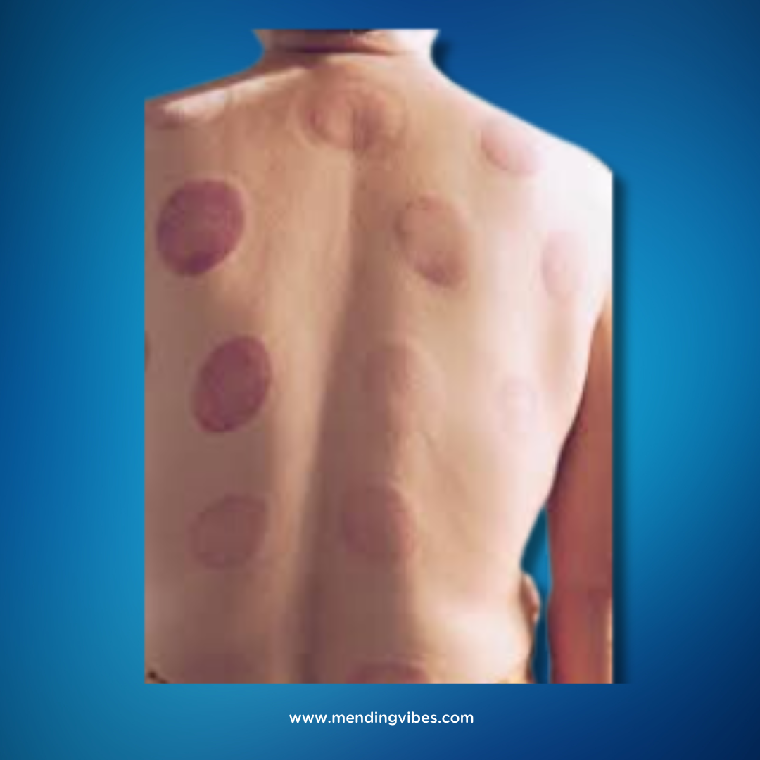Mending Vibes Electric Cupping Therapy